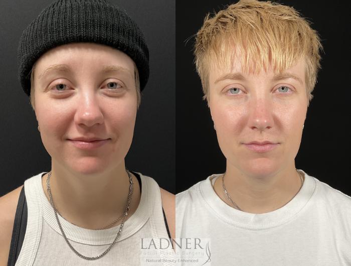 Chin Augmentation Case 245 Before & After Front | Denver, CO | Ladner Facial Plastic Surgery