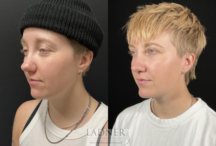 Chin Augmentation Case 245 Before & After Left Oblique | Denver, CO | Ladner Facial Plastic Surgery