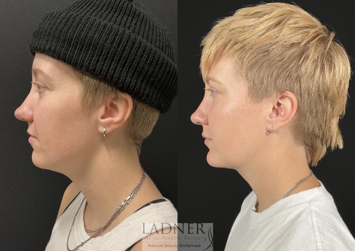 Chin Augmentation Case 245 Before & After Left Side | Denver, CO | Ladner Facial Plastic Surgery