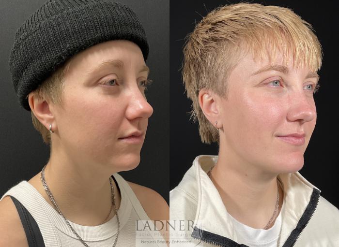 Chin Augmentation Case 245 Before & After Right Oblique | Denver, CO | Ladner Facial Plastic Surgery