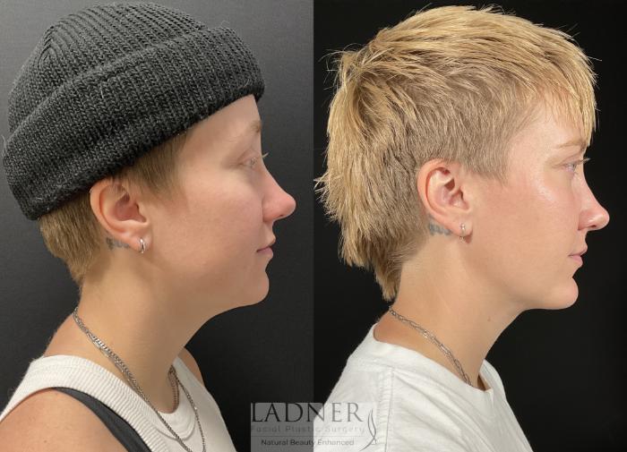 Chin Augmentation Case 245 Before & After Right Side | Denver, CO | Ladner Facial Plastic Surgery