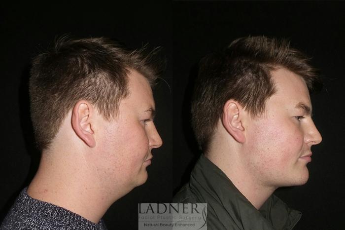 Facial Plastic Surgery for Men Case 28 Before & After Right Side | Denver, CO | Ladner Facial Plastic Surgery