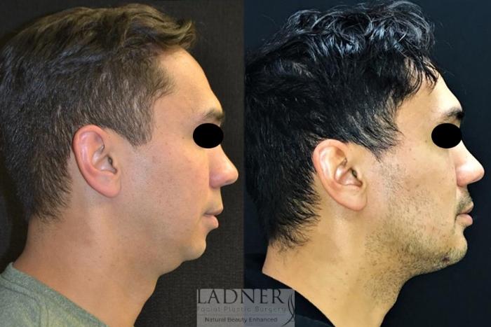 Chin Augmentation Case 67 Before & After Right Side | Denver, CO | Ladner Facial Plastic Surgery