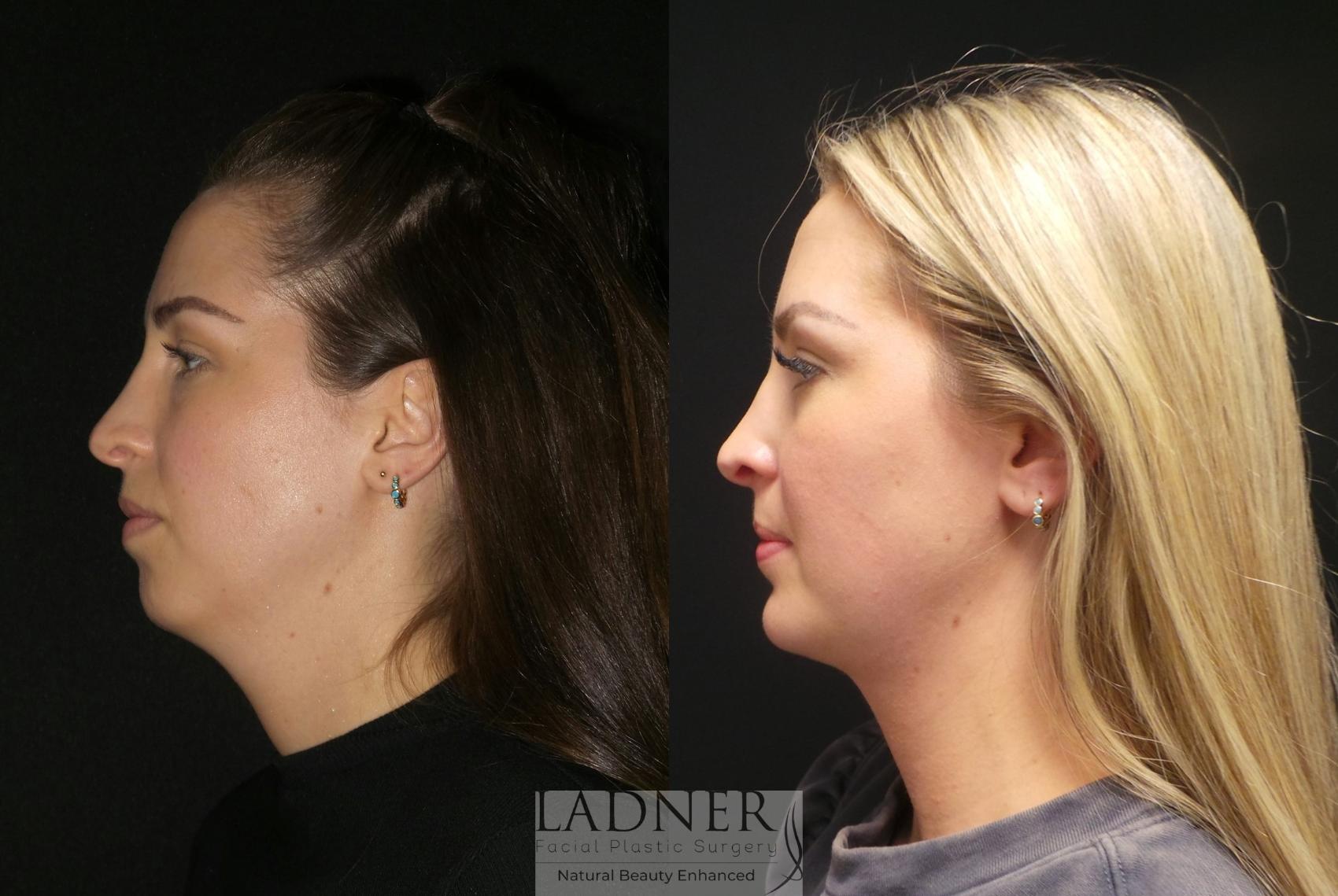Before: Submental Liposuction, Chin Augmentation