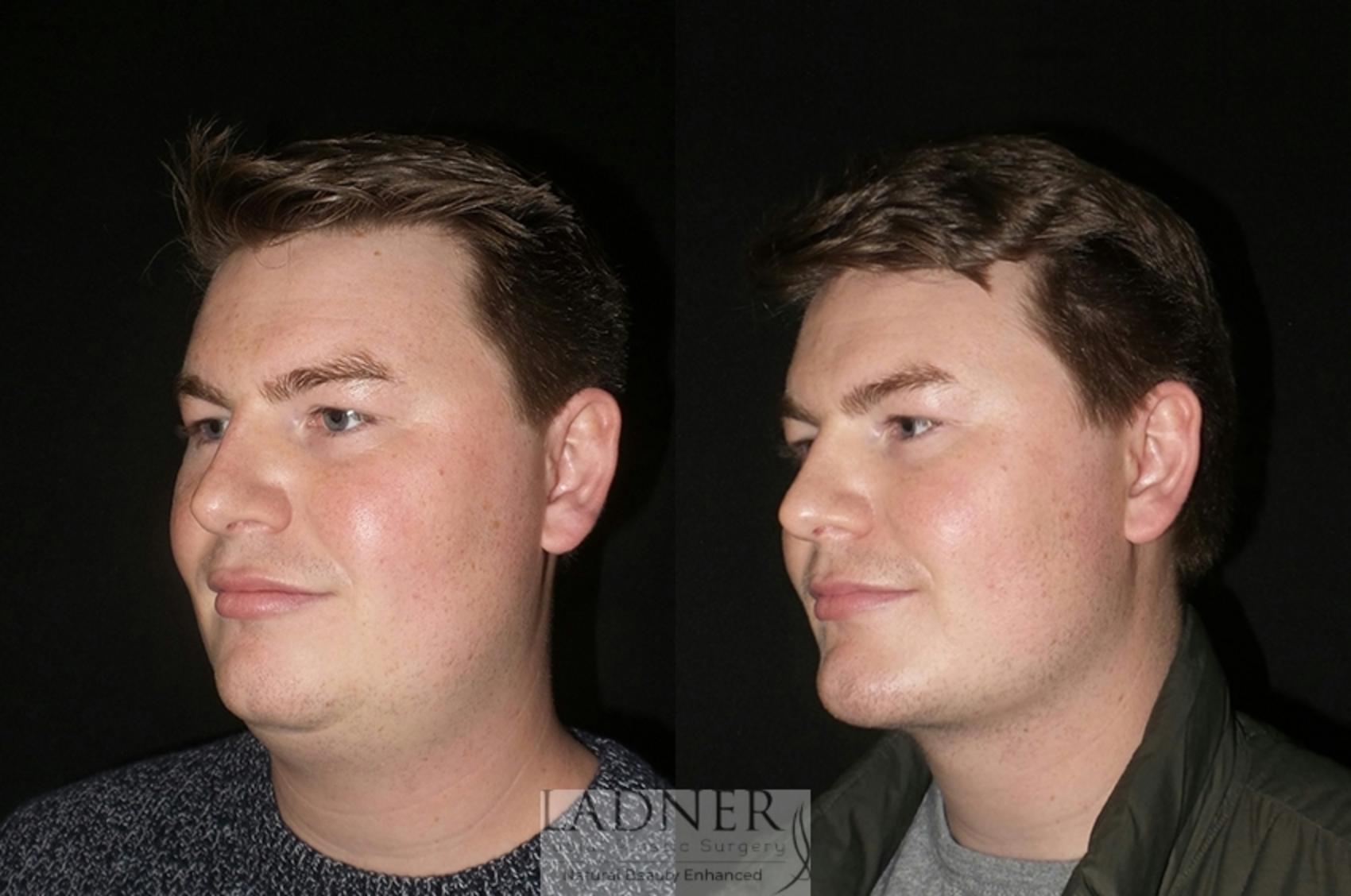 Chin Augmentation / Buccal Fat Removal Case 28 Before & After Left Oblique | Denver, CO | Ladner Facial Plastic Surgery