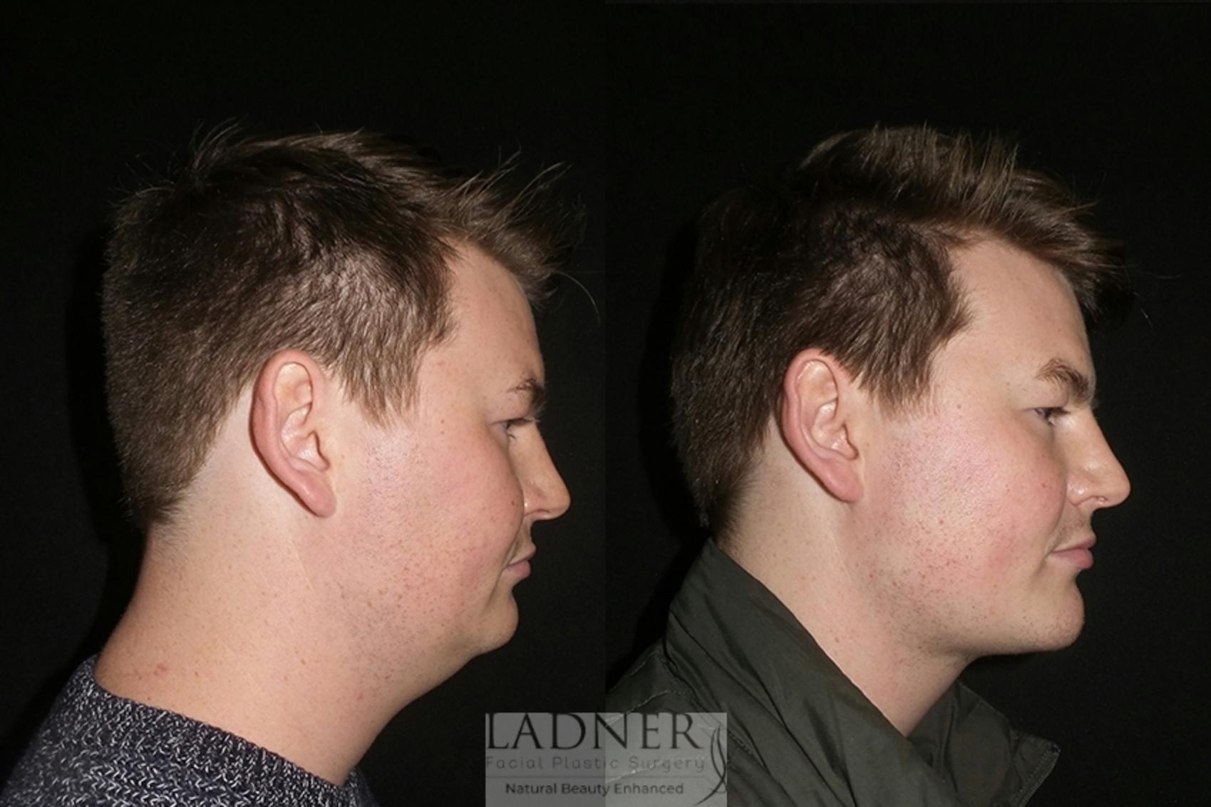 Chin Augmentation / Buccal Fat Removal Case 28 Before & After Right Side | Denver, CO | Ladner Facial Plastic Surgery