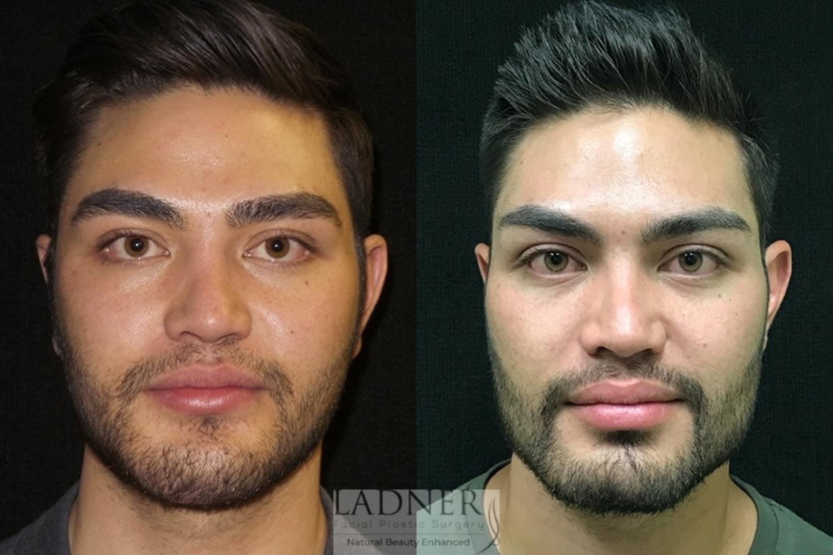 Facial Plastic Surgery for Men Case 66 Before & After Front | Denver, CO | Ladner Facial Plastic Surgery