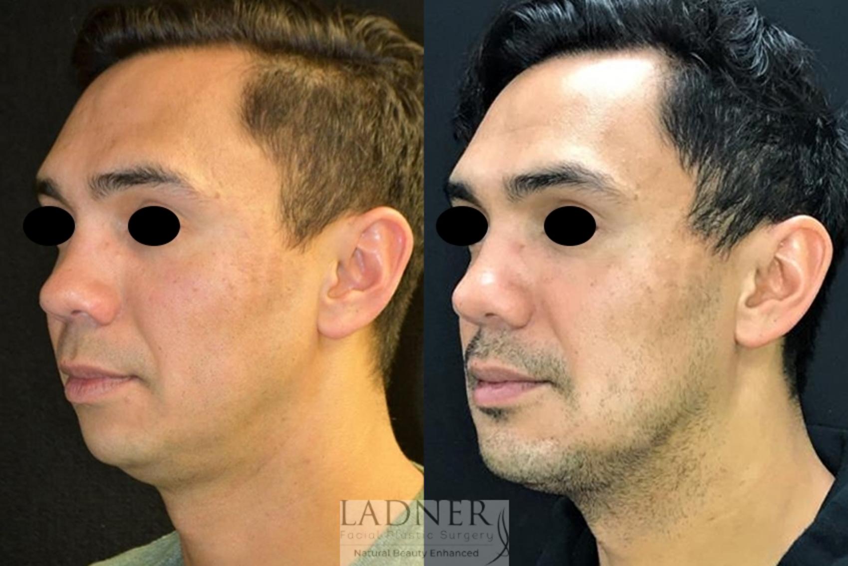 Chin Augmentation / Buccal Fat Removal Case 67 Before & After Left Oblique | Denver, CO | Ladner Facial Plastic Surgery