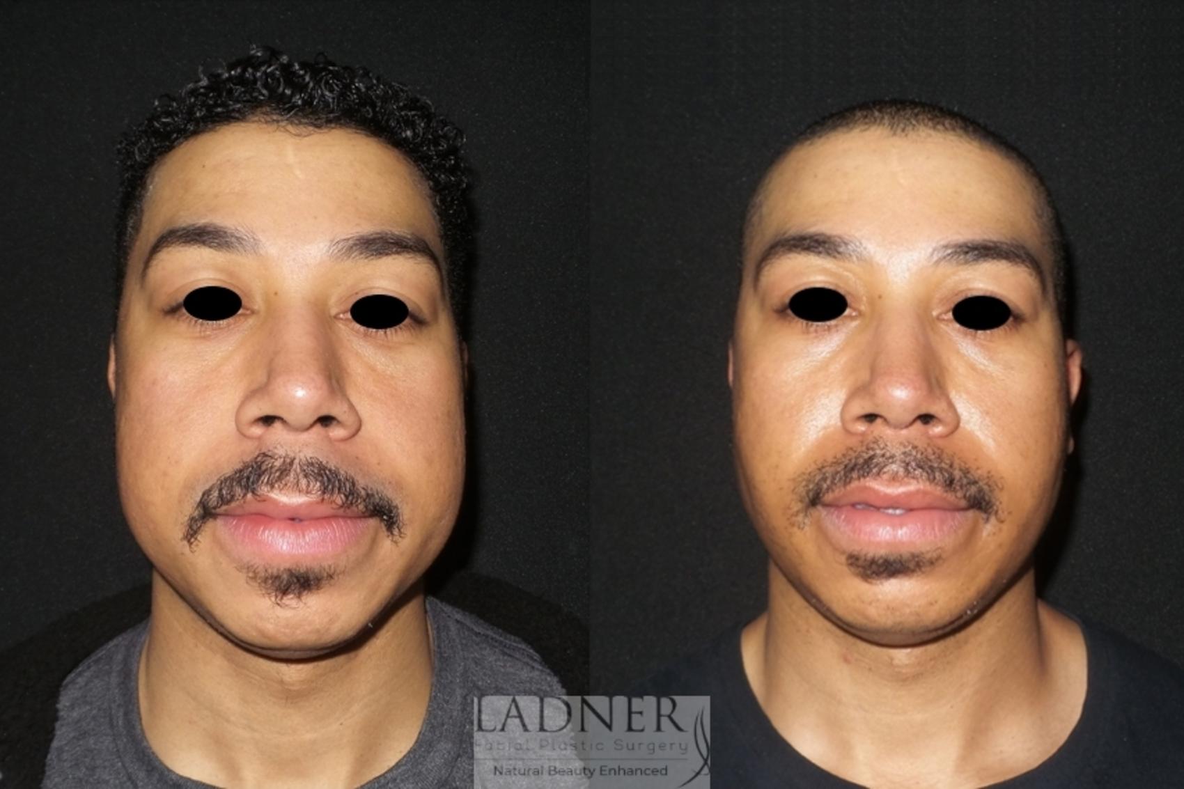 Chin Augmentation / Buccal Fat Removal Case 69 Before & After Front 2 | Denver, CO | Ladner Facial Plastic Surgery