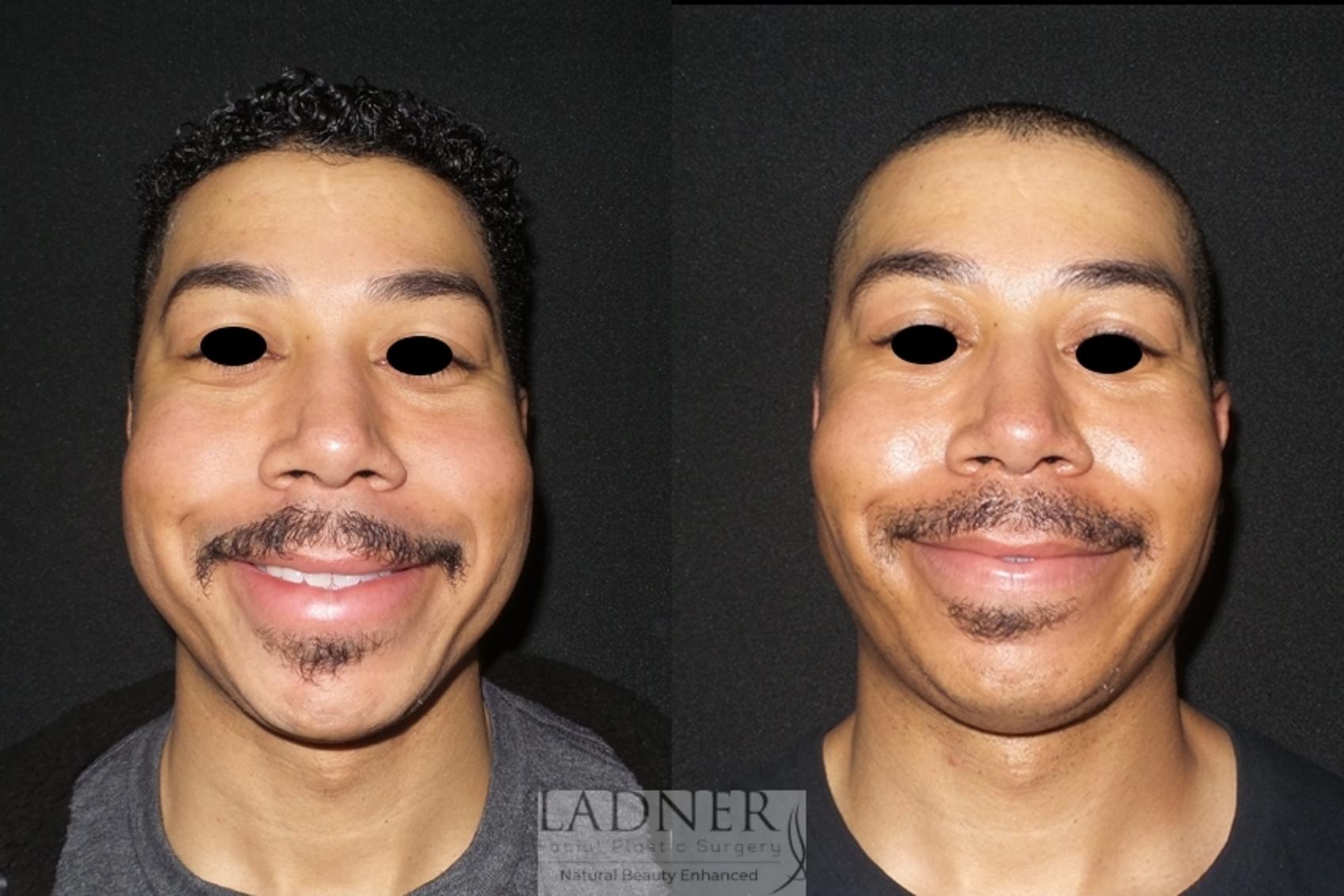 Chin Augmentation / Buccal Fat Removal Case 69 Before & After Front | Denver, CO | Ladner Facial Plastic Surgery