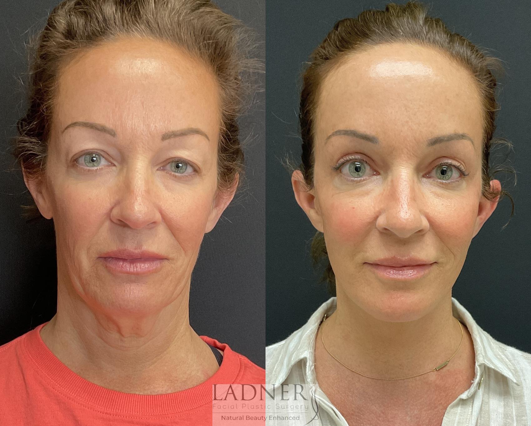 Deep Plane Facelift / Neck Lift Case 202 Before & After Front | Denver, CO | Ladner Facial Plastic Surgery