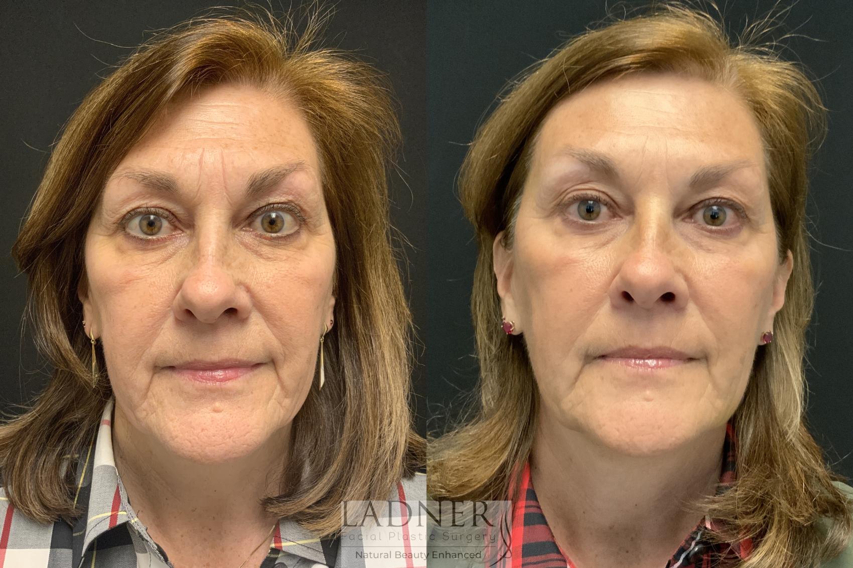 Before: Sculptra and Dysport