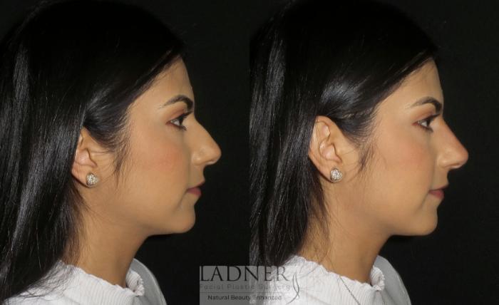 Dermal Fillers Case 180 Before & After Right Side | Denver, CO | Ladner Facial Plastic Surgery