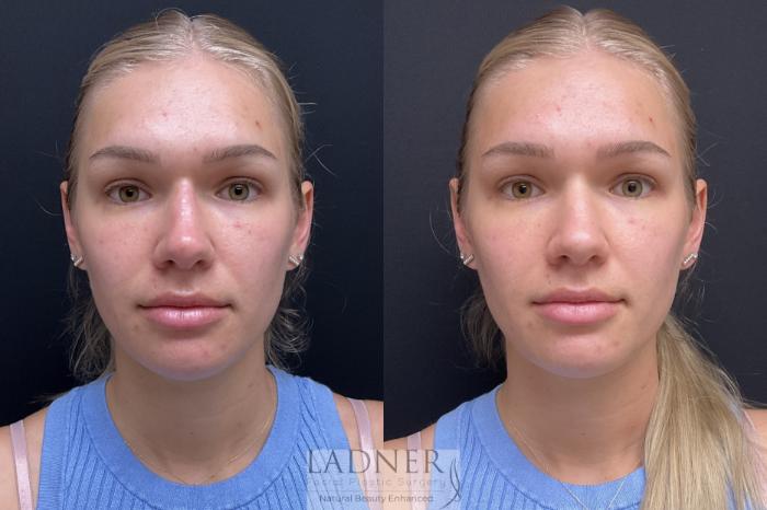 Dermal Fillers Case 195 Before & After Front | Denver, CO | Ladner Facial Plastic Surgery