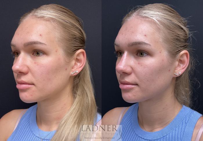 Dermal Fillers Case 195 Before & After Left Oblique | Denver, CO | Ladner Facial Plastic Surgery