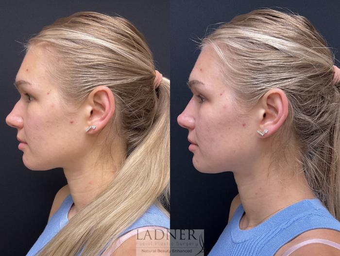 Dermal Fillers Case 195 Before & After Left Side | Denver, CO | Ladner Facial Plastic Surgery