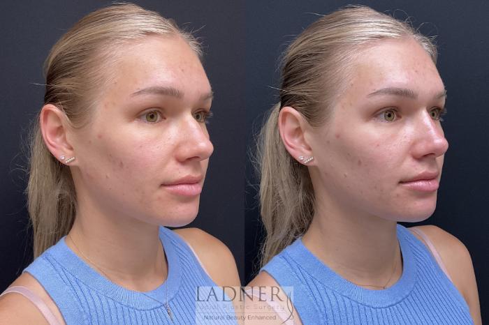 Dermal Fillers Case 195 Before & After Right Oblique | Denver, CO | Ladner Facial Plastic Surgery