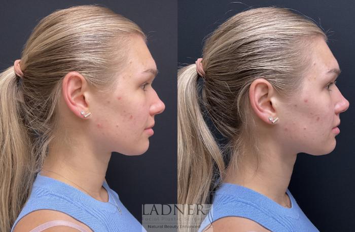 Dermal Fillers Case 195 Before & After Right Side | Denver, CO | Ladner Facial Plastic Surgery
