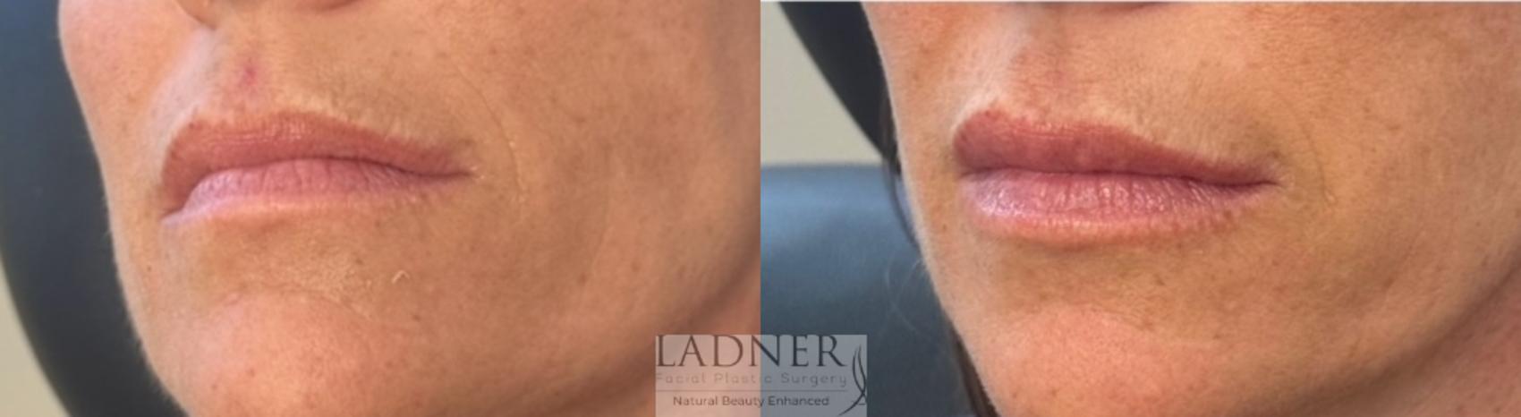 Dermal Fillers Case 203 Before & After Front | Denver, CO | Ladner Facial Plastic Surgery