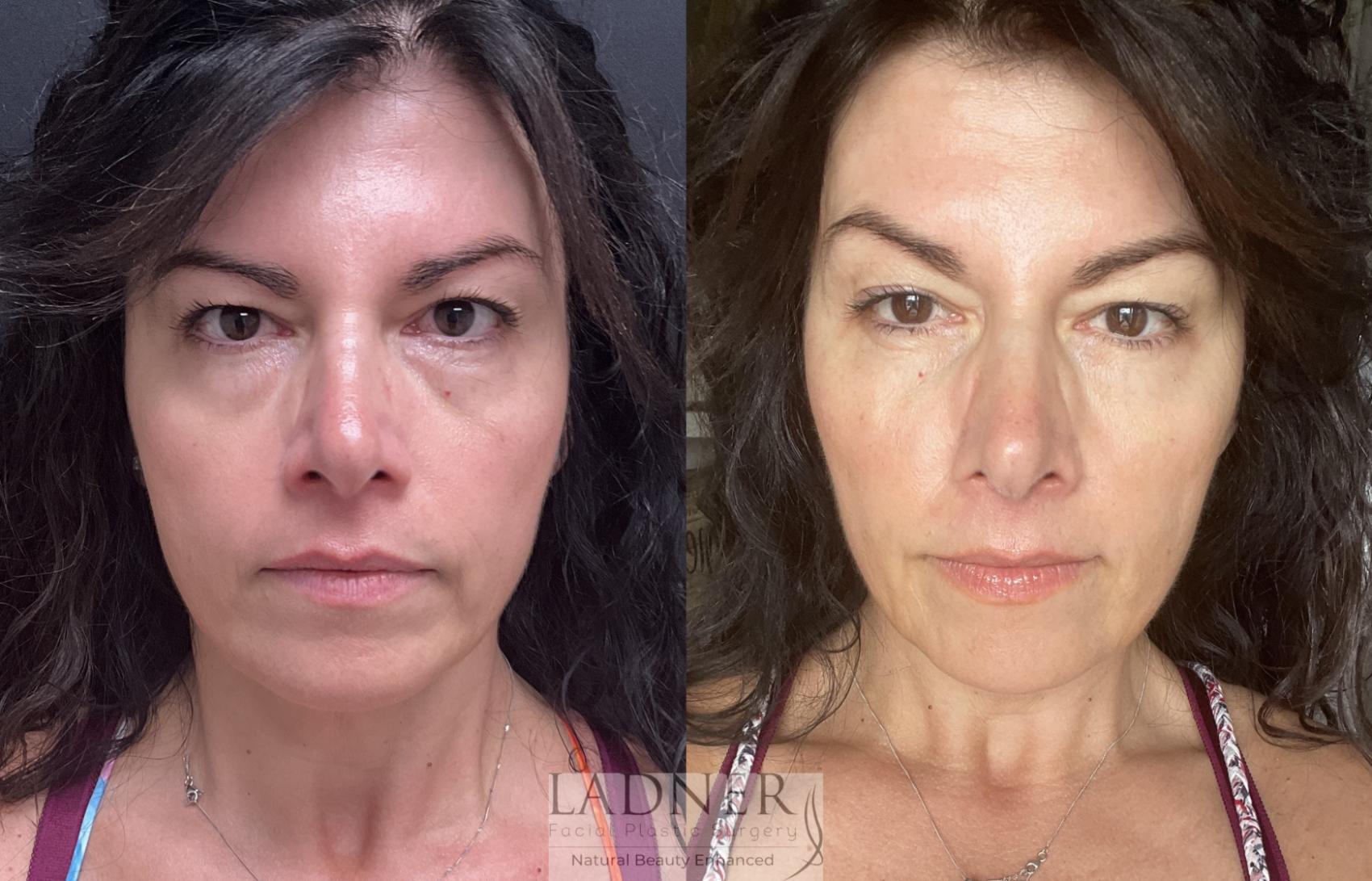 Dermal Fillers Case 205 Before & After Front | Denver, CO | Ladner Facial Plastic Surgery