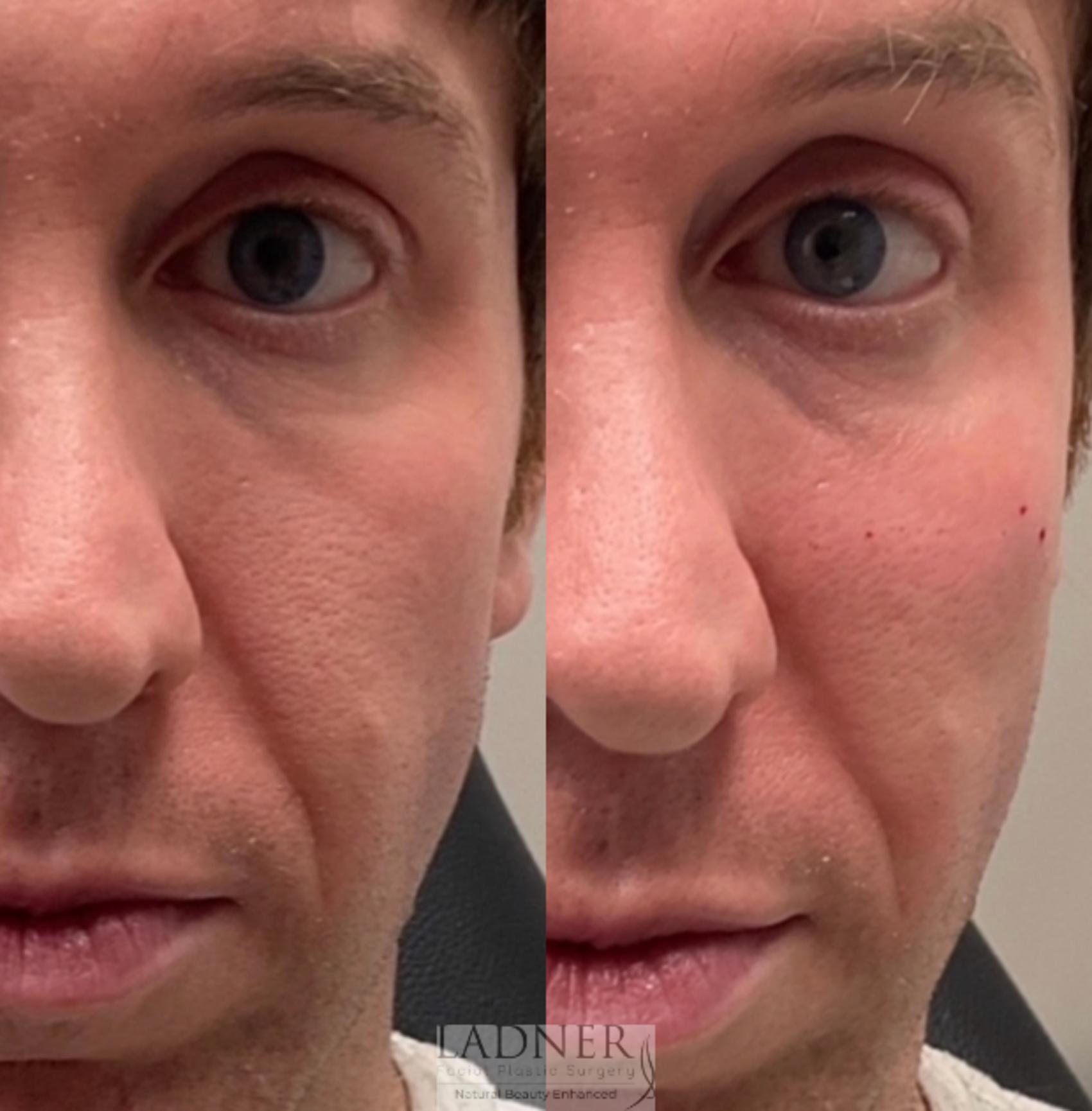 Dermal Fillers Case 208 Before & After Left Side | Denver, CO | Ladner Facial Plastic Surgery