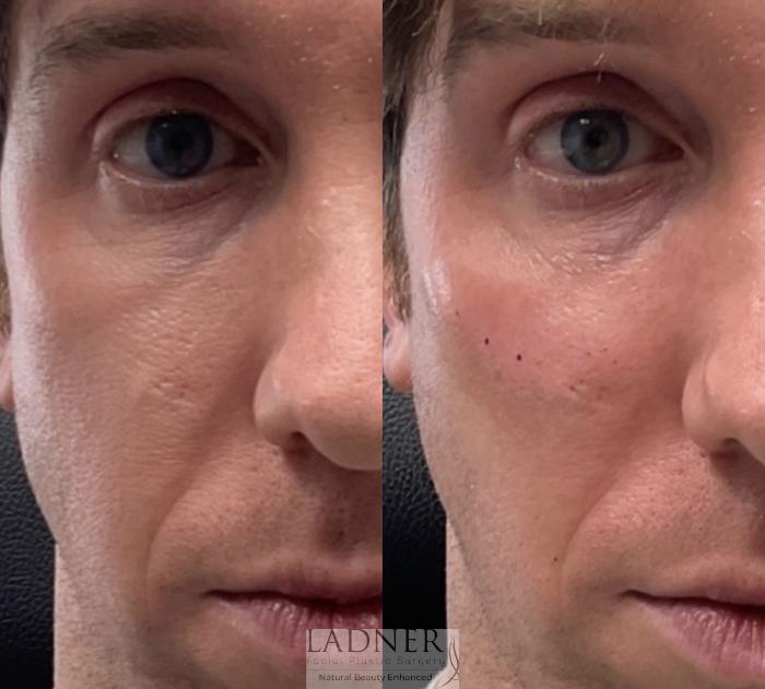 Dermal Fillers Case 208 Before & After Right Side | Denver, CO | Ladner Facial Plastic Surgery