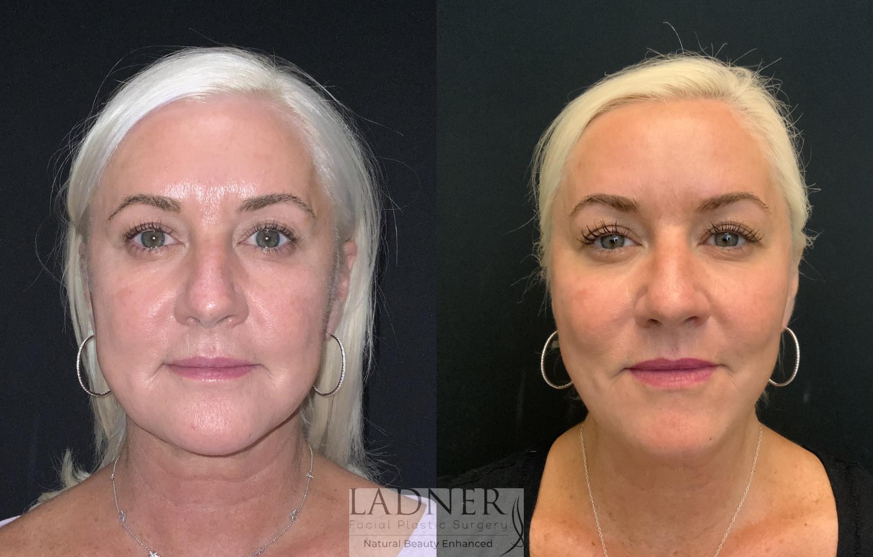 Dermal Fillers Case 221 Before & After Front | Denver, CO | Ladner Facial Plastic Surgery