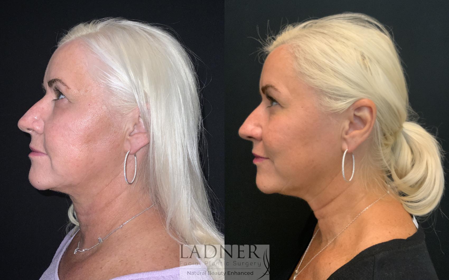 Dermal Fillers Case 221 Before & After Left Side | Denver, CO | Ladner Facial Plastic Surgery
