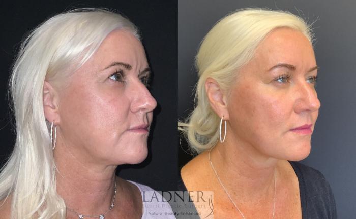 Dermal Fillers Case 221 Before & After Right Oblique | Denver, CO | Ladner Facial Plastic Surgery