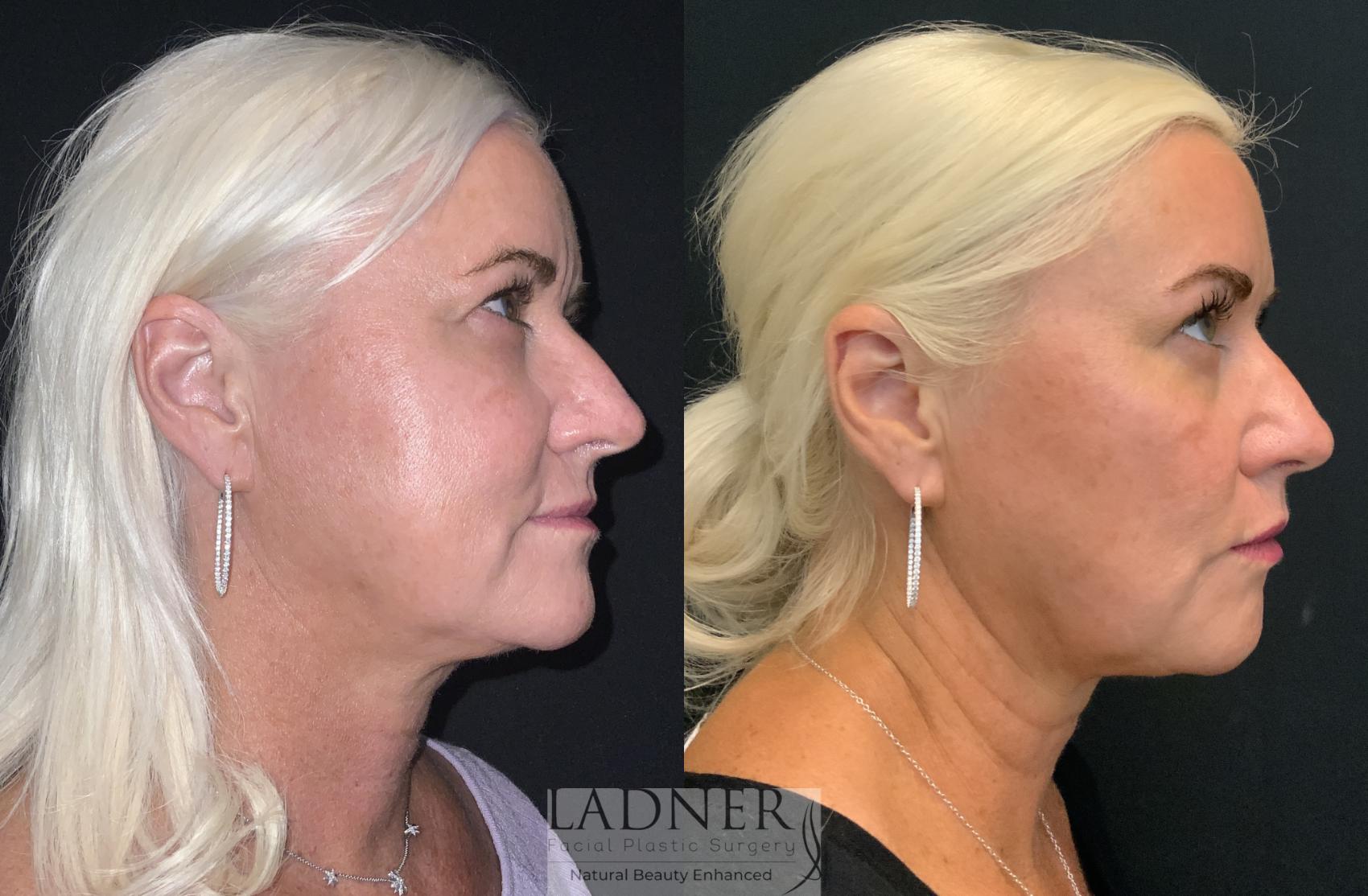 Dermal Fillers Before And After Pictures Case 221 Denver Co Ladner Facial Plastic Surgery