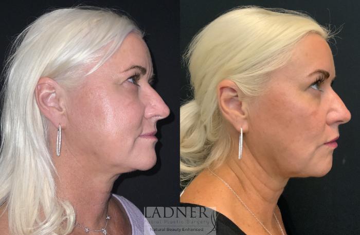 Dermal Fillers Case 221 Before & After Right Side | Denver, CO | Ladner Facial Plastic Surgery