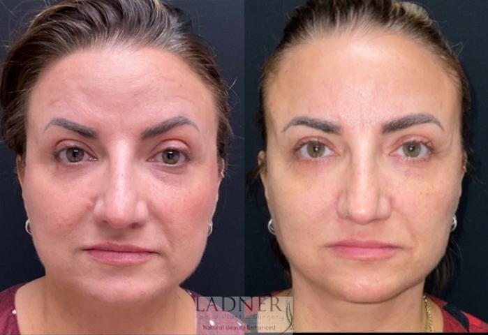 BOTOX® Cosmetic Case 230 Before & After Before and after 1 Treatment (2 vials of Sculptra) | Denver, CO | Ladner Facial Plastic Surgery