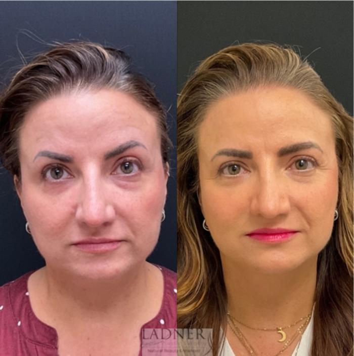 BOTOX® Cosmetic Case 230 Before & After Before and after 2 Treatments (4 total vials of Sculptra) | Denver, CO | Ladner Facial Plastic Surgery