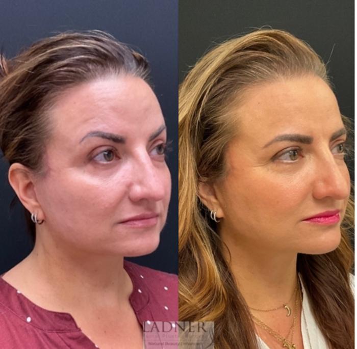 Dermal Fillers Case 230 Before & After Before and after 2 Treatments | Denver, CO | Ladner Facial Plastic Surgery