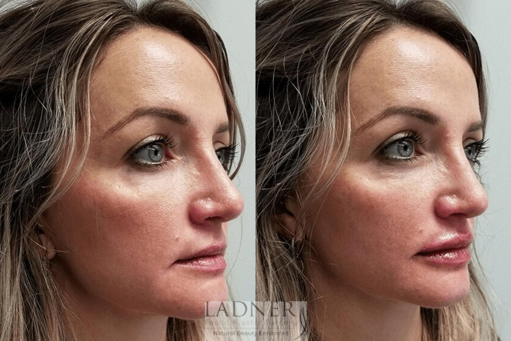 Dermal Fillers Case 76 Before & After Right Oblique | Denver, CO | Ladner Facial Plastic Surgery