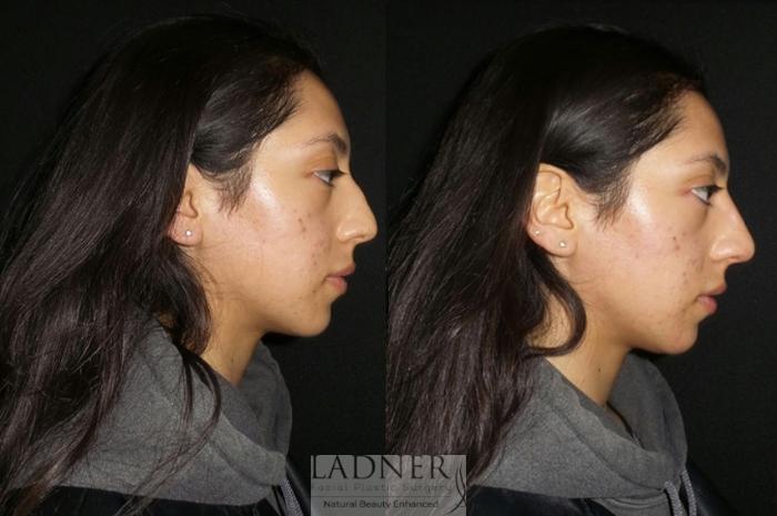 Dermal Fillers Case 77 Before & After Right Side | Denver, CO | Ladner Facial Plastic Surgery
