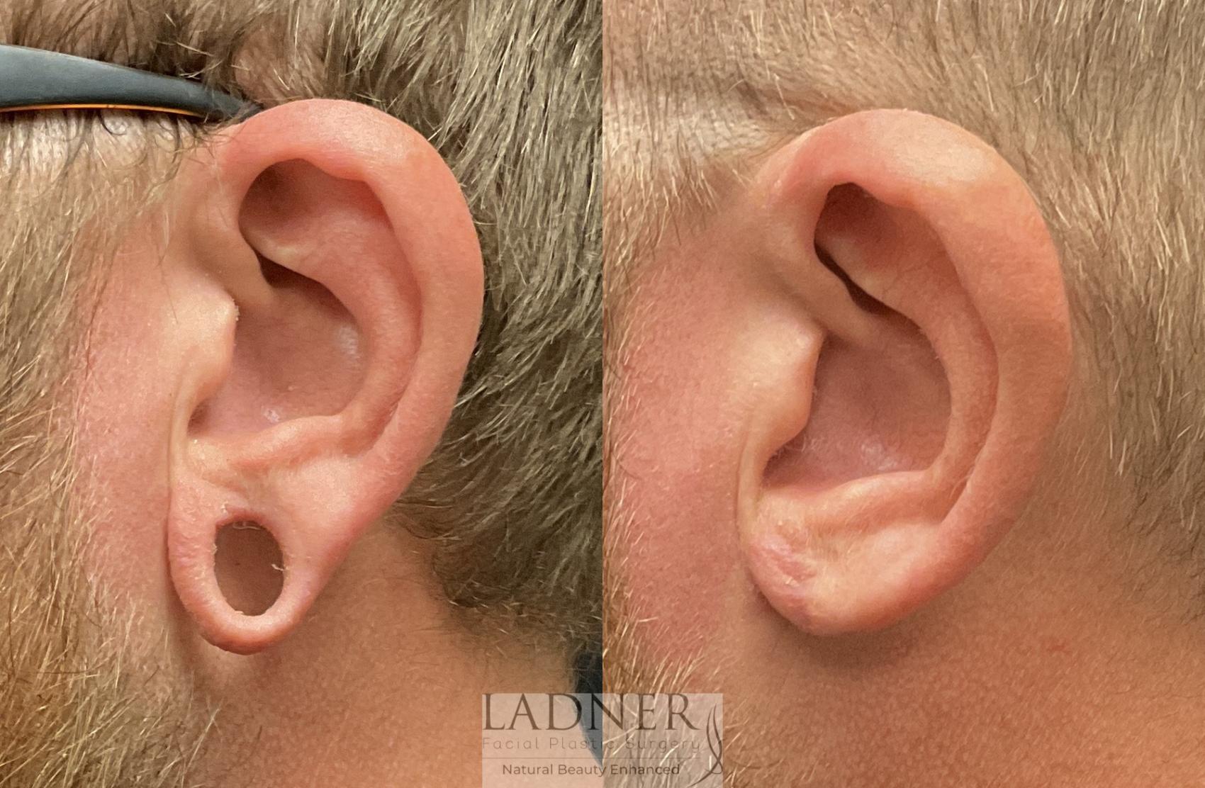 Ear Surgeries Before and After Pictures Case 186 Denver, CO Ladner