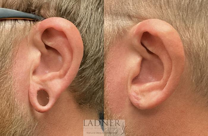 Ear Surgeries Case 186 Before & After Left Side | Denver, CO | Ladner Facial Plastic Surgery