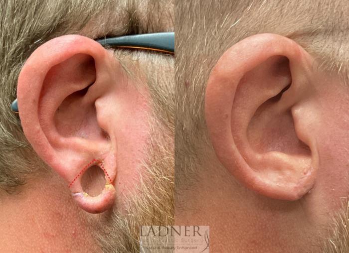 Ear Surgeries Case 186 Before & After Right Side | Denver, CO | Ladner Facial Plastic Surgery