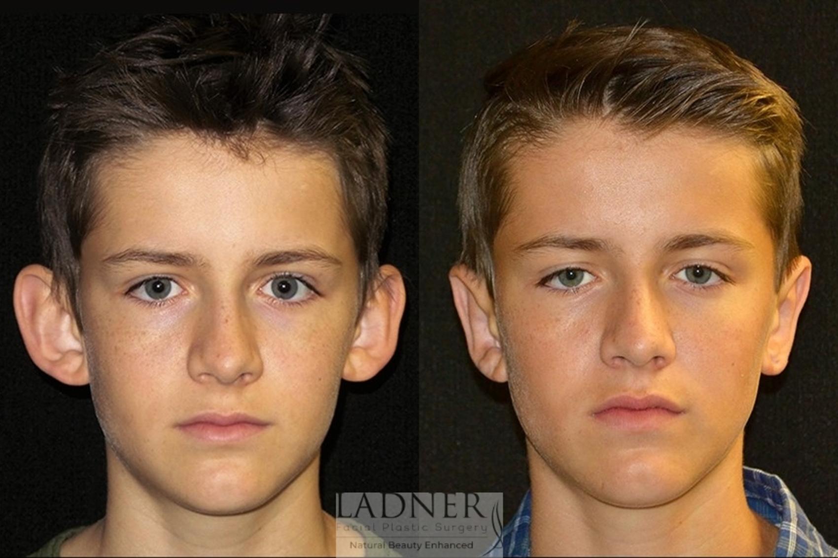 Ear Surgeries Case 62 Before & After Front | Denver, CO | Ladner Facial Plastic Surgery