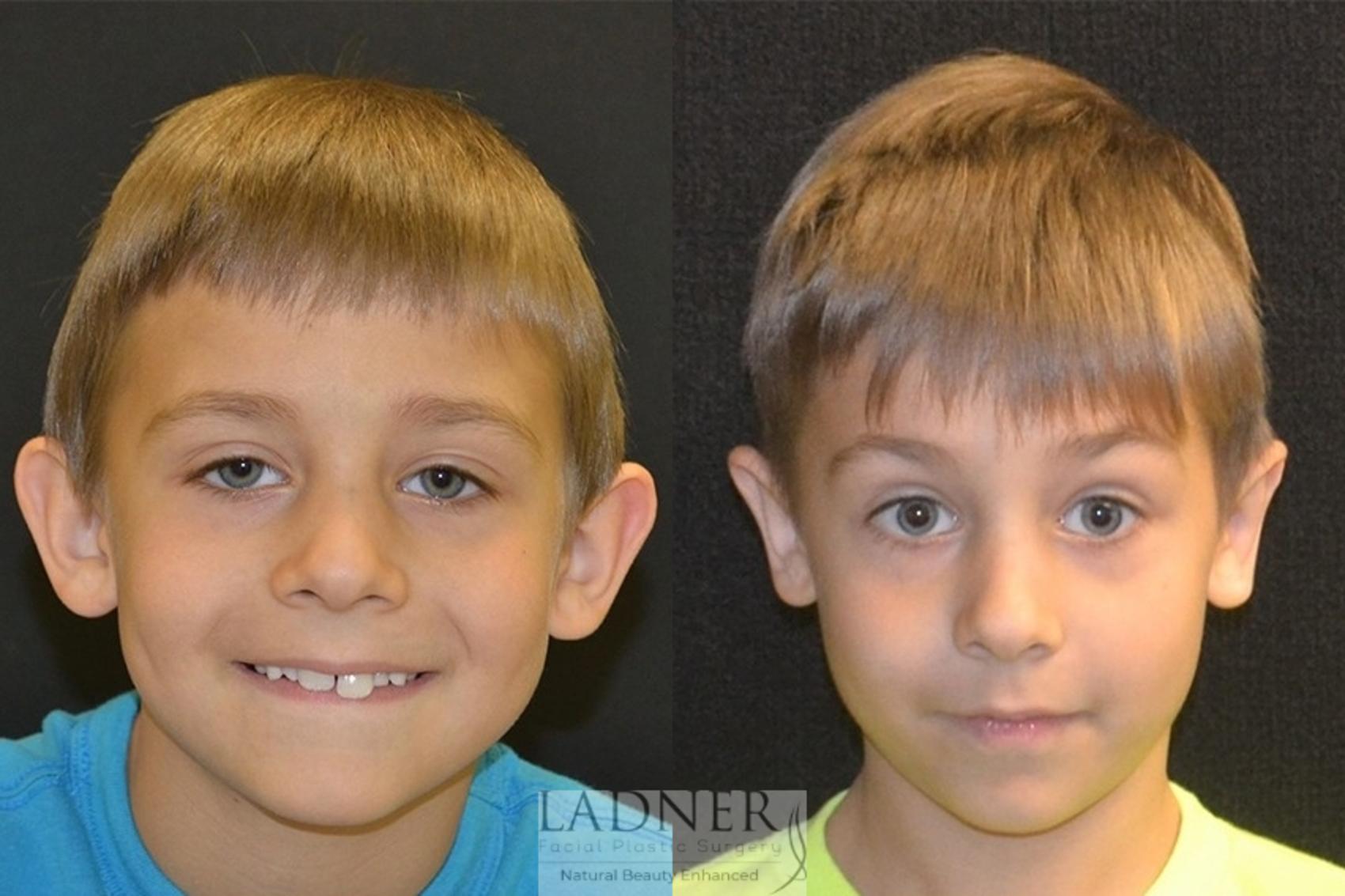 Ear Surgeries Case 63 Before & After Front | Denver, CO | Ladner Facial Plastic Surgery