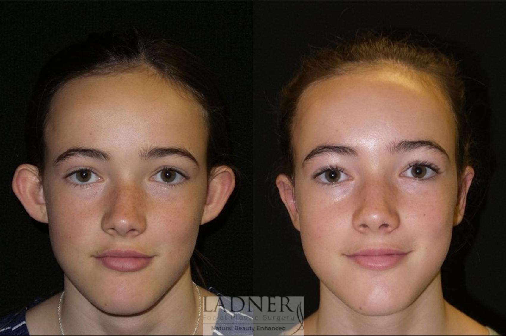 Ear Surgeries Case 64 Before & After Front | Denver, CO | Ladner Facial Plastic Surgery