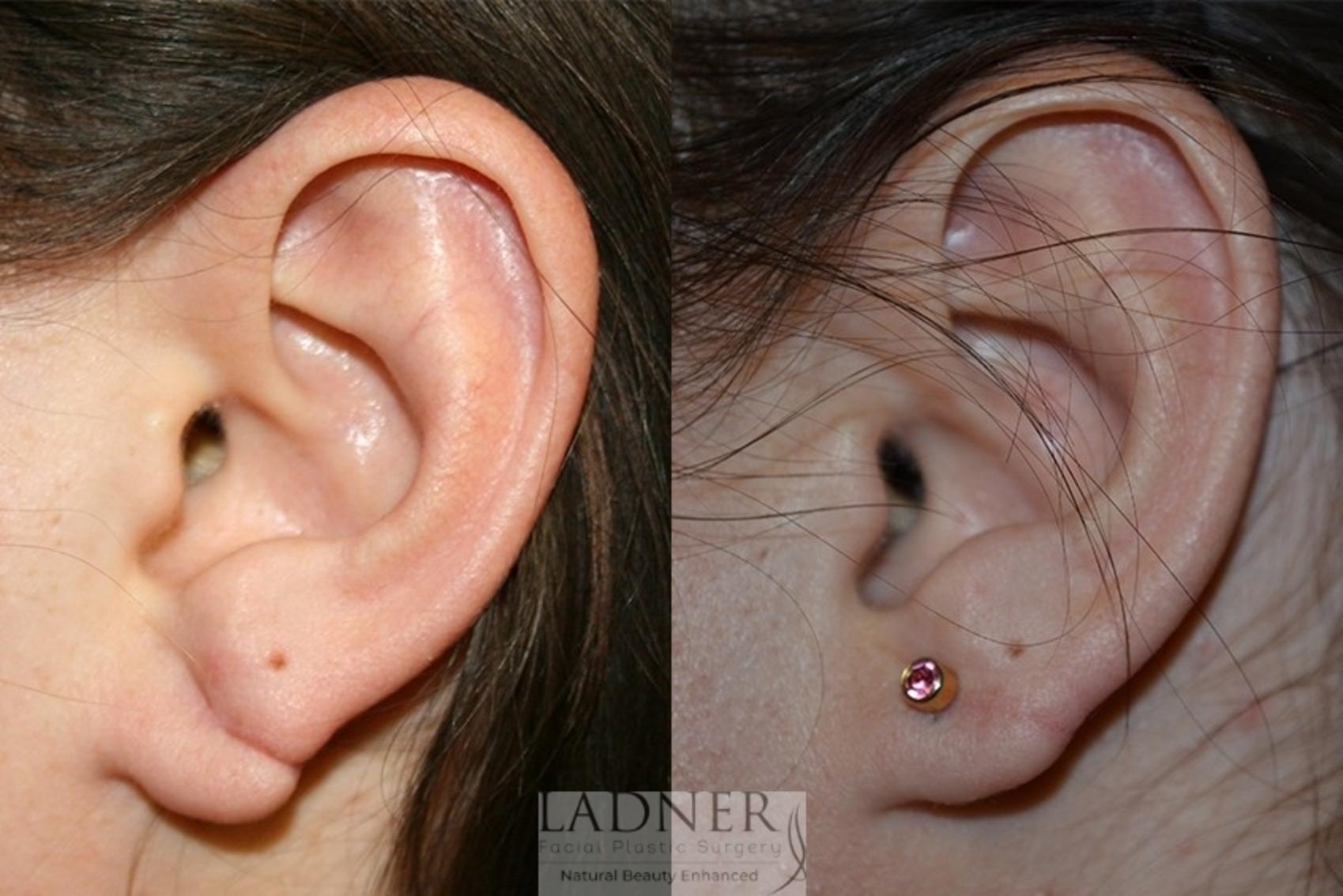 Ear Surgeries Case 65 Before & After Side | Denver, CO | Ladner Facial Plastic Surgery