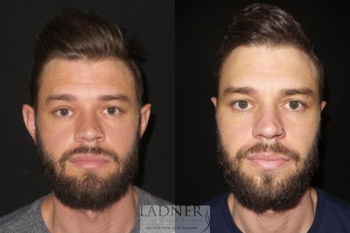 Facial Plastic Surgery for Men Case 83 Before & After Front | Denver, CO | Ladner Facial Plastic Surgery