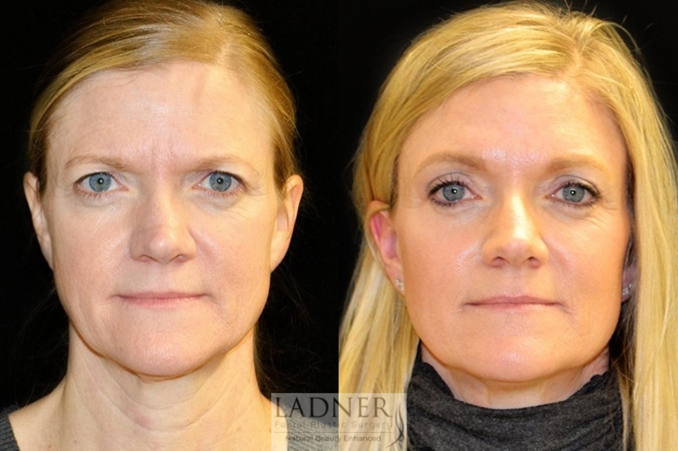 Brow Lift / Forehead Lift Case 20 Before & After Front | Denver, CO | Ladner Facial Plastic Surgery