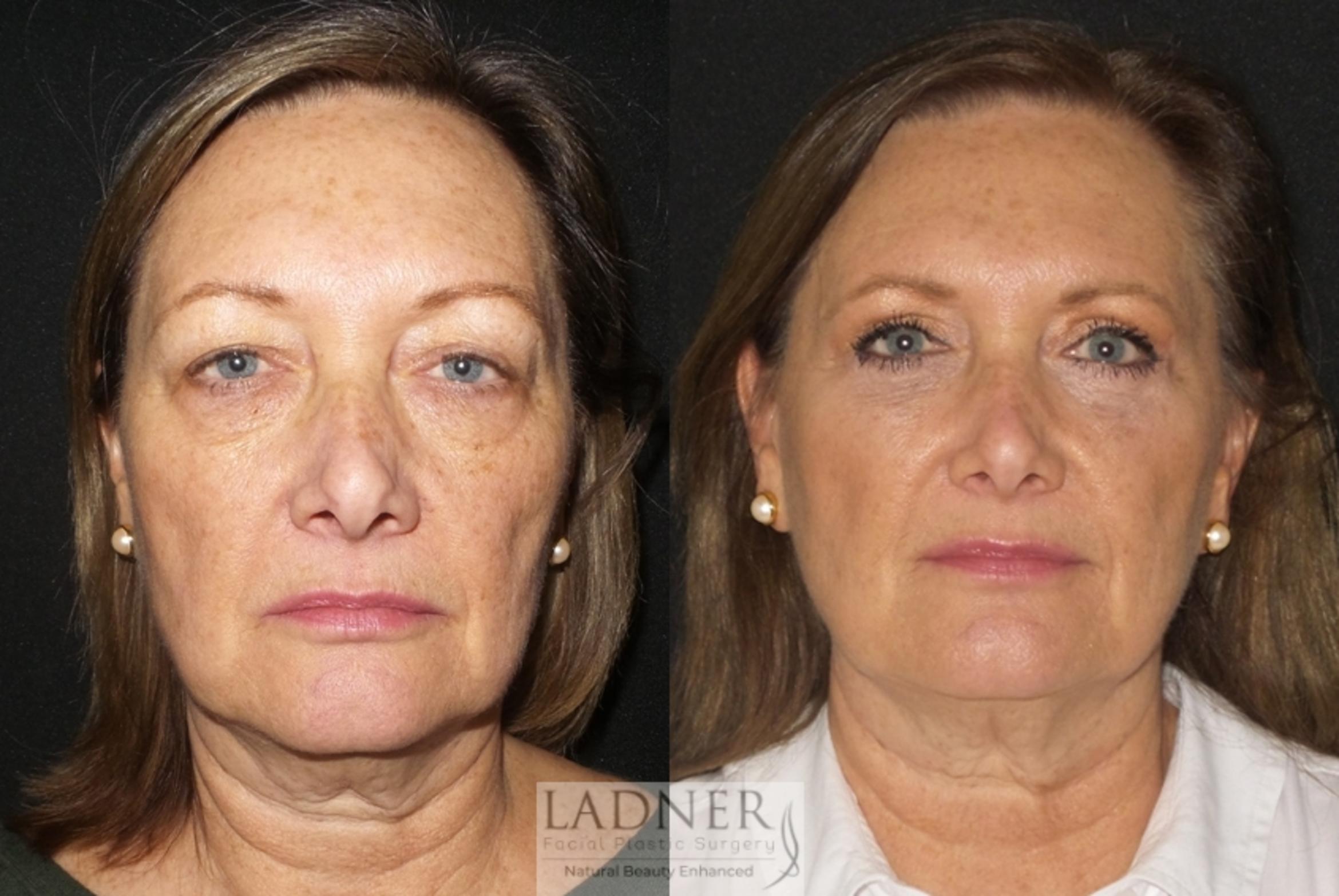 Eyelid Surgery (blepharoplasty) Case 21 Before & After Front | Denver, CO | Ladner Facial Plastic Surgery