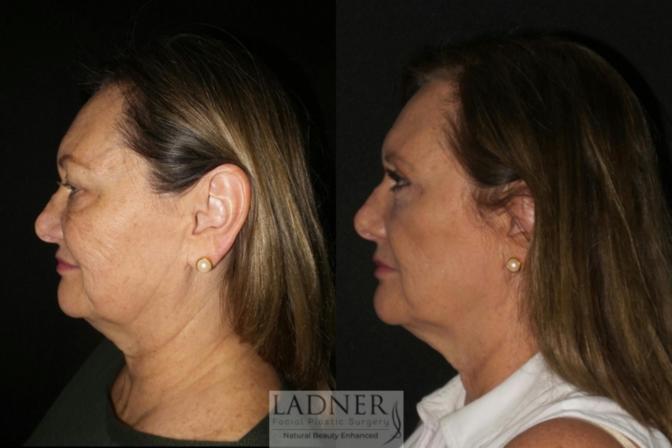 Eyelid Surgery (blepharoplasty) Case 21 Before & After Left Side | Denver, CO | Ladner Facial Plastic Surgery