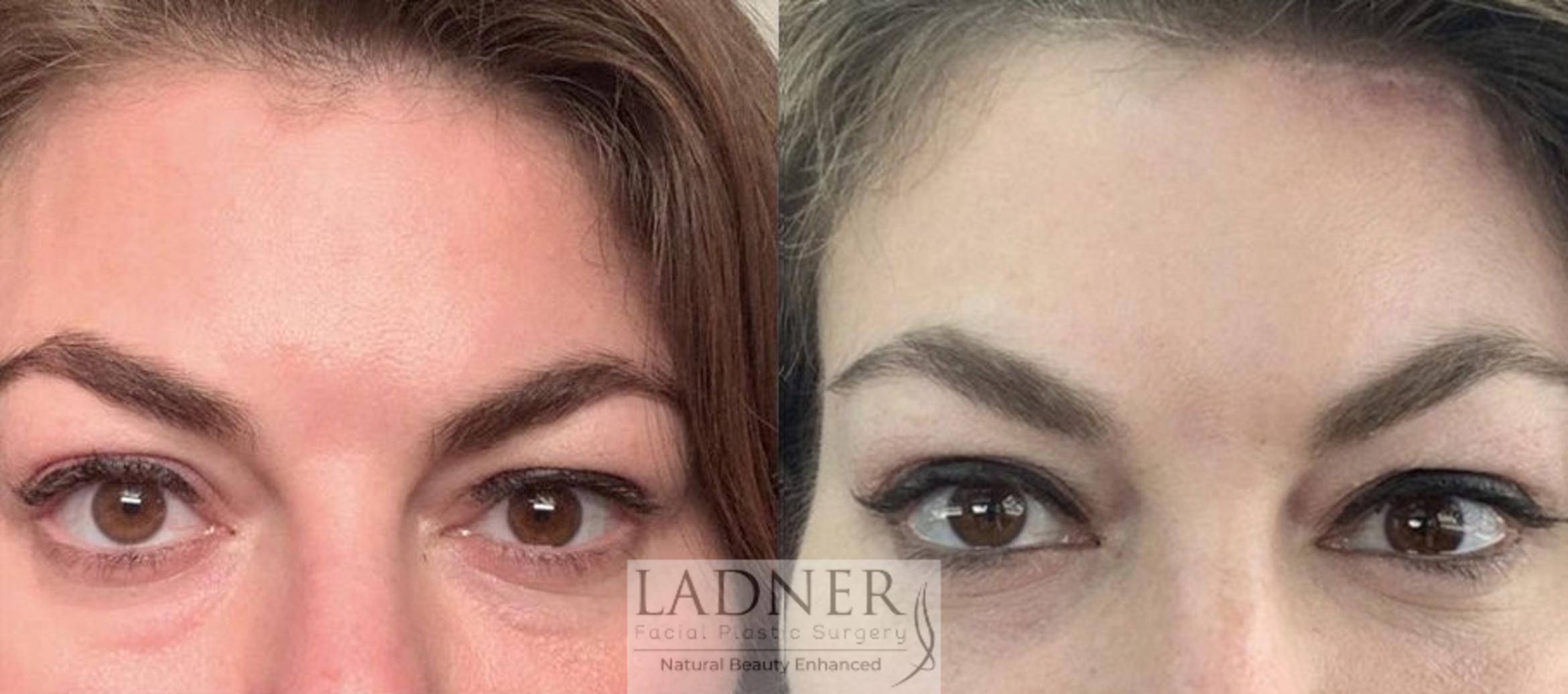 blepharoplasty eyelid surgery in denver co ladner facial plastic surgery