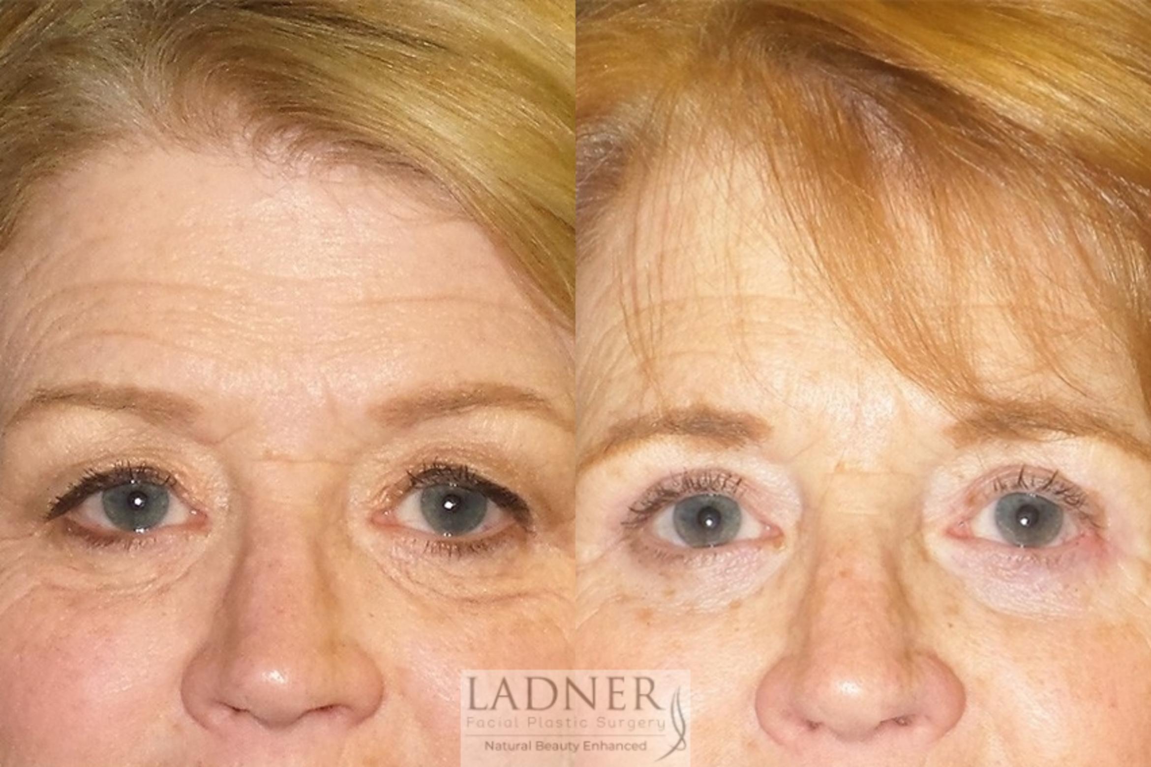 Eyelid Surgery (blepharoplasty) Case 52 Before & After Front | Denver, CO | Ladner Facial Plastic Surgery