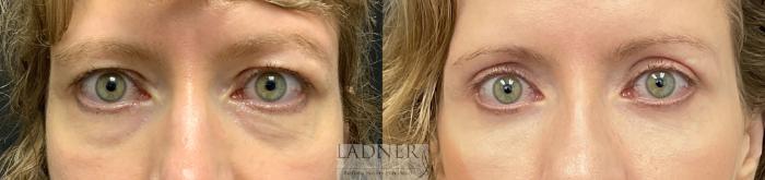 Eyelid Surgery (blepharoplasty) Case 153 Before & After Front | Denver, CO | Ladner Facial Plastic Surgery